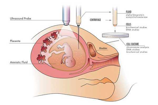 香港验血为啥那么贵,宫腔积液如何影响辅助生殖技术中助孕过程？